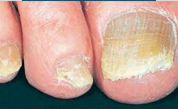 Close-up of feet with fungal nail infection