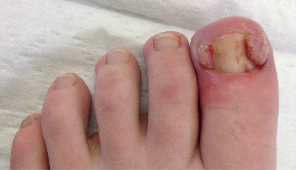 Ingrowing Toe Nail