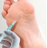 Dry-needling Result